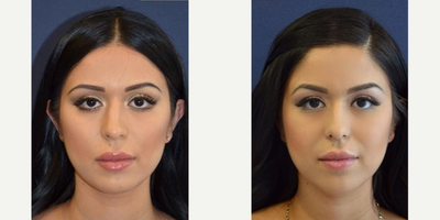 Woman treated with Rhinoplasty - Woman treated with Rhinoplasty
