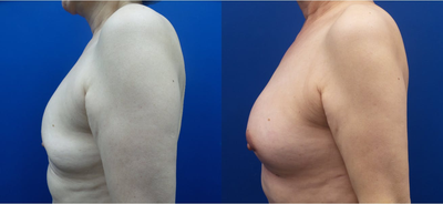 65-74 year old woman treated with Fat Transfer - 67-year-old woman treated with Autologous Fat Transfer to the breast. The patient had her implants removed and the volume was replaced with fat harvested from her abdomen and flanks and purified to inject into her breasts.