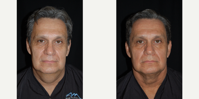45-54 year old man treated with Chin Liposuction - 5 months after Ultrasound Assisted Liposuction (UAL) of neck.