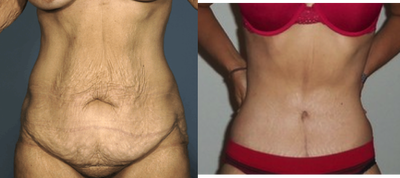 Complete Body Makeover - 
	This women underwent a body lift (360 degree tummy tuck), arm lift, thigh lift, breast lift along with facial treatments and could not be happier
