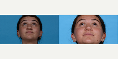 Woman treated with Alarplasty - Woman treated with Alarplasty