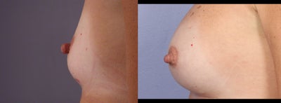 37 yr old Breast Augmentation Nipple Reduction - 	37 yr old mother of two had Breast Augmentation with the CPG Cohesive Gel Implants, placed under the muscle thru inframammary incisions. She also had Nipple Reduction as she was unhappy with her large nipples, having breast fed 2 children