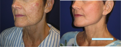 55-64 year old woman treated with a Face Lift, Neck Lift,  and Full Face CO2 Fractional Laser Skin Resurfacing   - This patient came to me full of energy. She is very active and lives a healthy lifestyle, however she felt like her appearance did not represent how she felt on the inside. After taking time to understand her goals and her aging pattern, I recommended a lower facelift, neck lift, and full face CO2 fractional laser skin resurfacing to recapture a more youthful appearance that complimented how she felt on the inside. One of my many goals is to achieve a natural looking result without any of the tell-tale signs of surgery. Her pictures are a little over 3 months after her procedure. Her recovery time was about 7 days.