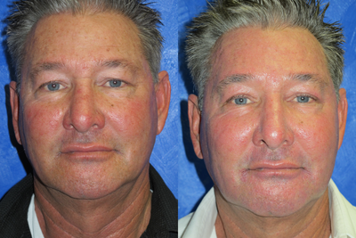 Active FX to face and eye lids - 
	wanted to improve his skin complexion
