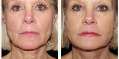 55-64 year old woman treated with ArteFill - 60 year old female received Bellafill to the perioral area; photos depict the patient's results 2 months post-op.