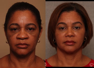 Ehtnic Rhinoplasty - Age 49; Rhinoplasty; 7 Months Post-Op