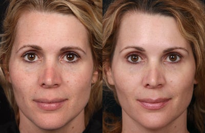 Non-Laser Resurfacing for Tone and Texture - Patient had a series of eMatrix treatments to improve texture of the skin, as well as pigmentation from sun damage. She was also treated with Platelet-Rich Plasma (PRP) to promote faster healing and added collagen stimulation.
