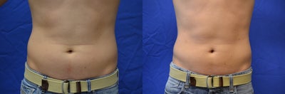 30 y/o male treated with SmartLipo Triplex to his abdomen - 30 y/o male who had a total of 1150 cc aspirated from his abdomen and flank under local anesthesia in the office using the SmartLipo Triplex system.