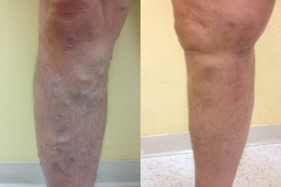 55  year old male with varicose veins treated by EVLT - Extensive varicose veins treated by endovenous laser ablation.