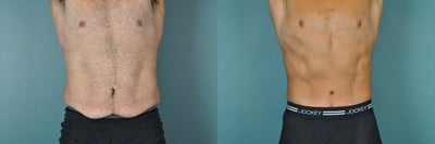 Lower Body Lift - 
	This patient underwent a Lower Body Lift.
