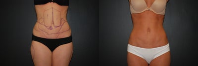 SMall volume liposculpting / liposuction - 
	Three months after liposculpture to abdomen/ flanks/ lower back/ and thighs
