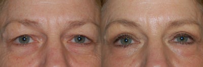 Eyelid Lift - 
	Eyelid Lift
