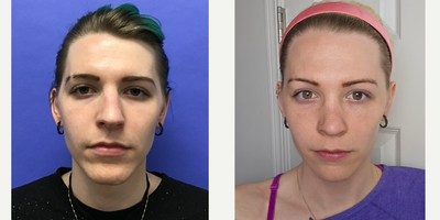 Patient treated with Transgender Facial Feminization Surgery, Facial Feminization Surgery, Septoplasty, Hair Transplant - 25 to 34 year-old female patient is 1 year post-op from Facial Feminization surgery. Her procedures included: Modified Coronal Forehead Lift and Supra Orbital Bone Reduction and Contouring, Chin Reduction and Contour, Thyroid Cartilage Shave, Septorhinoplasty with Cartilage Grafts, Fascia to Lips, and 300 Micrografts to the Fronto Temporal Recessions.