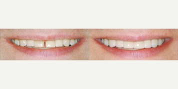 25-34 year old woman treated with Lumineers - Placement of Lumineers to correct the shape of the teeth