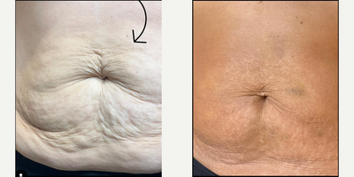 Woman treated with Sculptra, Skin Tightening, Thread Lift - Woman treated with Sculptra, Skin Tightening, Thread Lift