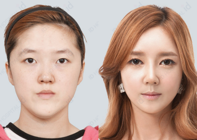 25-34 year old woman treated with V Line Surgery - V line + Ptosis Correction + Canthoplasty + Barbie Line Rhinoplasty in ID hospital