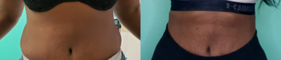 25-34 year old woman treated with Lipodissolve - Client received Lipo Dissolve on stomach area. 1 session 8 ml.