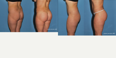 35-44 year old woman treated with Brazilian Butt Lift - Liposuction of lower back and hips followed by 400cc of fat grafting to each buttock.