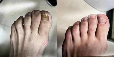 45-54 year old woman treated with Laser Toenail Fungus Removal - 4 months apart after laser onych treatment of the toenails for fungus removal