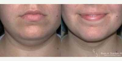 Woman treated with Chin Surgery - Woman treated with Chin Surgery