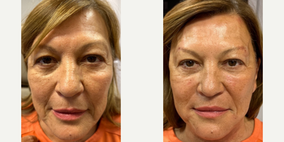 55-64 year old woman treated with Thread Lift - PDO thread lift with Miracu Threads and PRP Gel treatment. Before and immediately after treating lower face, brows and neck