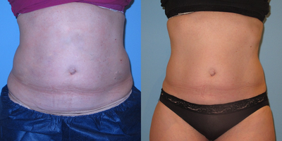 35-44 year old woman treated with CoolSculpting - 3 month result of 1 treatment on abdomen and thighs