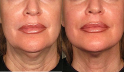 45-54 year old woman treated with Ultherapy - 45-54 year old woman treated with Ultherapy