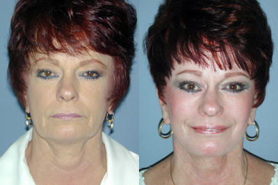 This 61-year-old Woman had a Face Lift, a Brow Lift, and an Upper and Lower Blepharoplasty - This 61-year-old Woman had a Face Lift, a Brow Lift, and an Upper and Lower Blepharoplasty.
