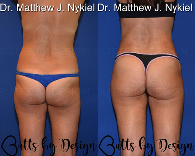Woman treated with Brazilian Butt Lift Revision - Woman treated with Brazilian Butt Lift Revision
