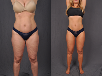 45-54 year old woman treated with Laser Liposuction - Liposuction of Abdomen, Waist, Hips & Inner Thighs
