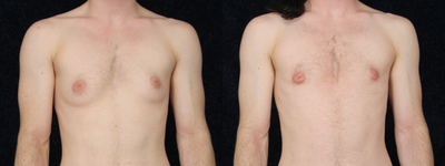25-34 year old man treated with FTM Keyhole Mastectomy - 26 yo male, 5'4 and 133 lbs. He had been on hormone therapy (testosterone) for 2 years and had been binding for 6 years. The doctor performed a keyhole mastectomy and removed 140 grams from each breast. His post-op photos are at 3 months.