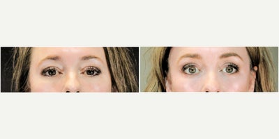 Woman treated with Eyelid Surgery, Brow Lift - Woman treated with Eyelid Surgery, Brow Lift