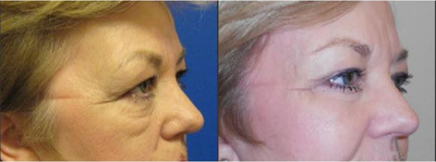 55-64 year old woman treated with Eyelid Surgery - Had excess skin of the upper and lower eyelids removed.