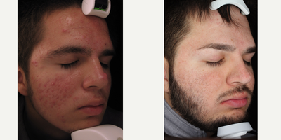 25-34 year old man treated with Intracel - This patient had 2-3 treatments per year for 3 years