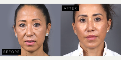 Woman treated with Eyelid Surgery, Deep Plane Facelift, Facial Fat Transfer, Lip Lift, Chin Implant - .- Blepharoplasty: Brightening and rejuvenating the eyes..- Deep Plane Mini Lift: Refining facial contours with elegance..- Fat Injections: Restoring youthful fullness and vitality..- Lip Lift: Perfectly enhancing the smile..- Chin Implant: Sculpting a harmonious, balanced profile.Surgery by Dr. James Marotta