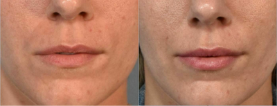 Woman treated with Restylane - Woman treated with Restylane.
