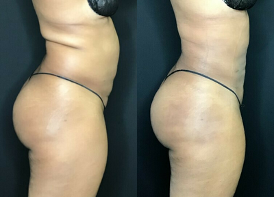 Woman treated with BeautiFill - Fat removal to the abdomen with light waist contouring.