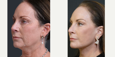 65-74 year old woman treated with Facelift, Facial Fat Transfer, Dermabrasion, Eyelid Surgery - This patient underwent a 3-D (Y-SMAS) facelift, facial fat transfer, lower blepharoplasty, CO2 lasabrasion and perioral medical diamond dermabrasionA 3-D (Y-SMAS) facelift is a more complete dissection employing 3 vectors. I consider it like a deep plane facelift but more sculptural and in my experience, it lasts longer and it is more effective for the nasolabial folds.