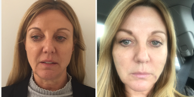 55-64 year old woman treated with Silhouette Soft - I treated this patient with 6 Silhouette Soft threads to address sagging skin contributing to nasolabial folds and jowls. The patient sent me this photo on day 3 post procedure. I find thread lifts can give a very nice lift of sagging skin and generally a 1cm lift can be achieved. The collagen stimulation achieved is a great added benefit in conditioning the skin.