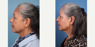 70 year old woman treated with Phenol Peel & Facial Fat Transfer to Temples, Tear Troughs, and Cheeks - Dr.Sukkar performed a Phenol Peel & Facial Fat Transfer to Temples (1cc per side), Tear Troughs (1cc per side), and Cheeks (5cc per side) to this 70 year old patient.