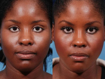 Secondary Rhinoplasty / African American Rhinoplasty Before and After - 	A secondary/revision rhinoplasty was performed via an open rhinoplasty approach to correct the wide and asymmetric tip and to increase the height of the bridge of this African American rhinoplasty patient who had undergone prior rhinoplasty in the past by another surgeon.