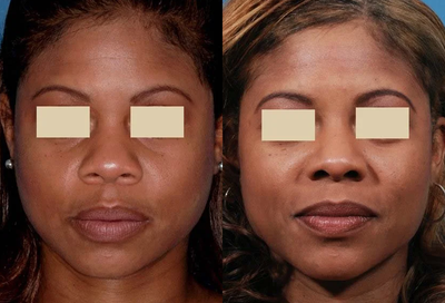 Rhinoplasty  - 	This African American patient underwent ethnic rhinoplasty to narrow her broad nose and narrow her nostrils.