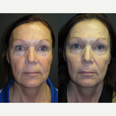 55-64 year old woman treated with Total FX - treated with total fx