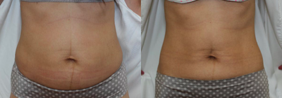 45-54 year old woman treated with UltraShape Power - UltraShape Power results post 3tx