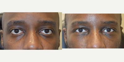 Eye Shape Change Surgery - Young man, with genetic protruding eyes and sad tired eye appearance underwent cosmetic orbital decompression (bulging eye surgery), lower eyelid retraction surgery with canthoplasty (almond eye surgery) and infraorbital rim silicone implant. Note improved eye appearance.