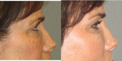 55-64 year old woman treated with Brow Lift - This vibrant woman visited our Center seeking rejuvenation of her eyelids (along with her lower face and neck).  She was unhappy about the drooping of both her brow and upper eyelid skin.  She stated that her eyes felt heavy, especially at the end of the day and that her friends and family consistently asked why she looked so tired.  After examination and consultation together we decided to proceed with a lateral Brow Lift and an Upper Blepharoplasty to help rejuvenate the upper half of her face.  Her result is a very natural, yet noticeable, improvement in the appearance of her lid and brow position.  After her procedure she also admitted to her eyes feeling less tired at the end of the day due to the decrease in weight on her eyelids.