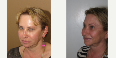 45-54 year old woman treated with Facelift - facelift and midface lift