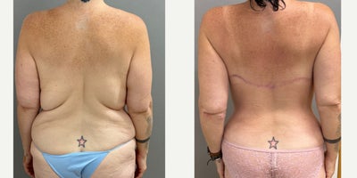 45-54 year old woman treated with Back Lift - 45 yo s/p back lift/ bra line lift performed in our on site AAAA certified operating suite.