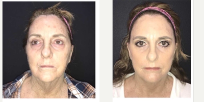 55-64 year old woman treated with Neck Lift - Elite face and neck lift, blepharoplasty upper & lower and laser resurfacing perioral & periocular