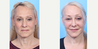 55-64 year old transgender woman treated with Facial Feminization Surgery, Transgender Facial Feminization Surgery, Facial Fat T - Comprehensive facial feminization surgery (brows, forehead bone, orbital bone, nose, lips, chin, cheeks, jaw, neck) followed by facelifting, eyelid surgery, fat grafting to face.